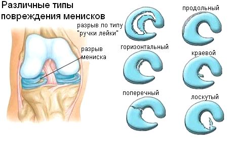 Как предотвратить боли в коленной чашечке