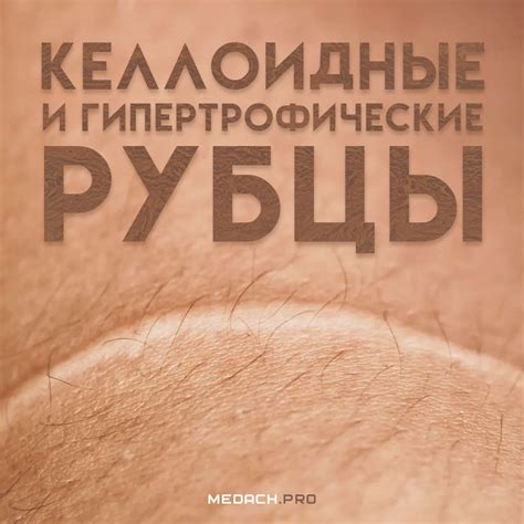 Как предотвратить гипертрофические рубцы
