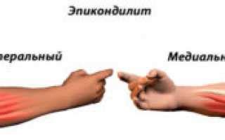 Как распознать медиальный эпикондилит