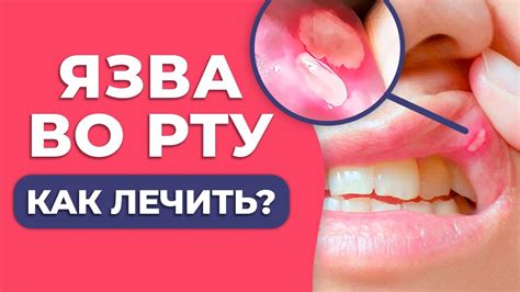 Как устранить сухость во рту после еды лука