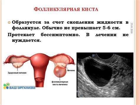Колоноскопия и киста яичника: