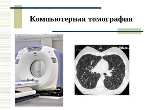 Компьютерная томография: точный расчет объема легочной ткани