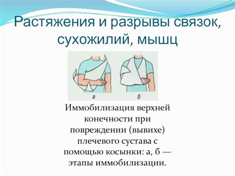 Консервативное управление при повреждении связок верхней конечности