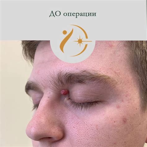 Лазерное удаление родинок