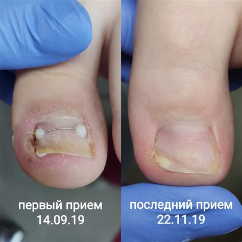 Лечение вросшего ногтя и гнойничков