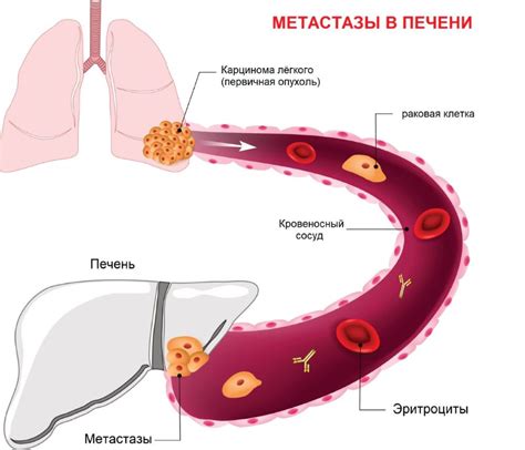 Лечение и профилактика метастазов в печени