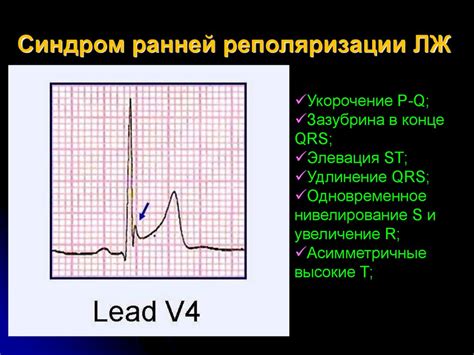 Лечение нарушения процесса реполяризации нижней стенки