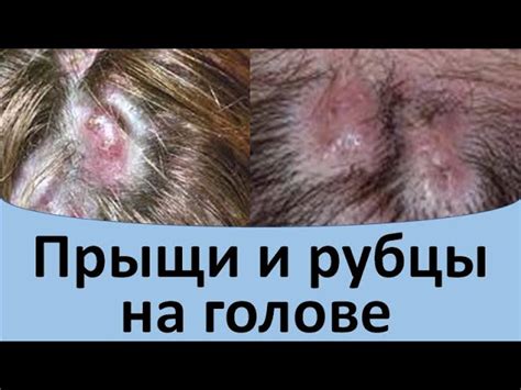 Лечение прыщей на голове