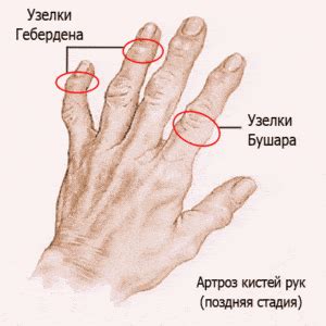 Лечение узелков Гебердена народными средствами