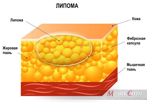 Липома