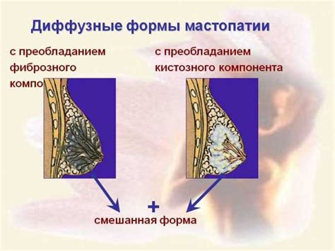 Мастопатия и ее связь с архитектоникой молочных желез