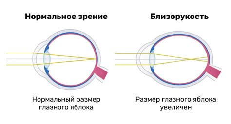 Материнская миопия и генетика