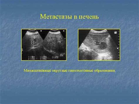 Метастазы в печени: причины, симптомы, диагностика