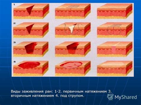 Методика нанесения Траумеля на рану