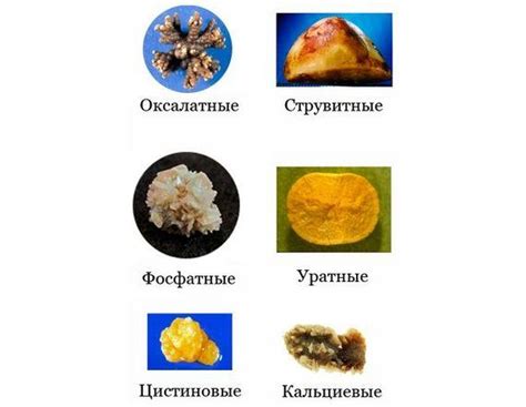 Методы анализа камней в почках