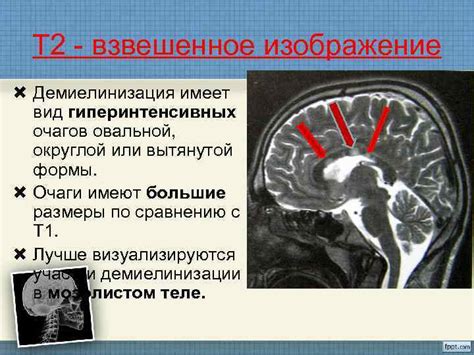 Методы выявления гиперинтенсивных очагов