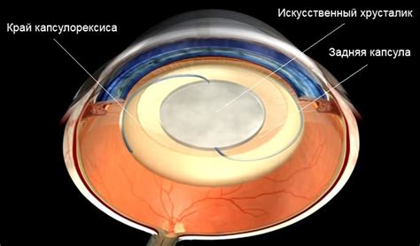 Методы замены хрусталика