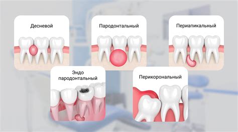 Методы лечения капюшона на десне