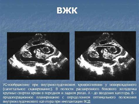 Методы лечения кровоизлияния в мозг у новорожденных