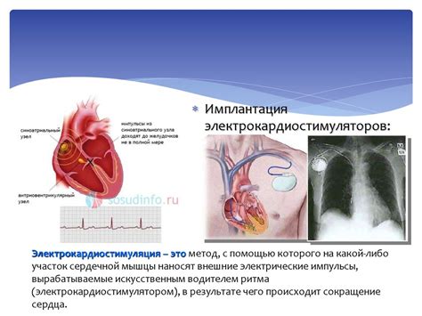 Методы лечения нарушений желудочковой проводимости