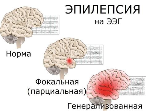 Методы лечения эпилепсии