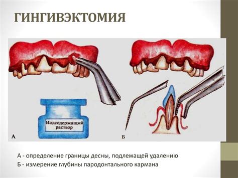 Методы приклеивания: открытый или закрытый способ