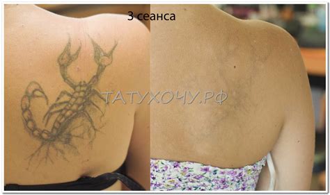 Методы удаления татуировок и их последствия
