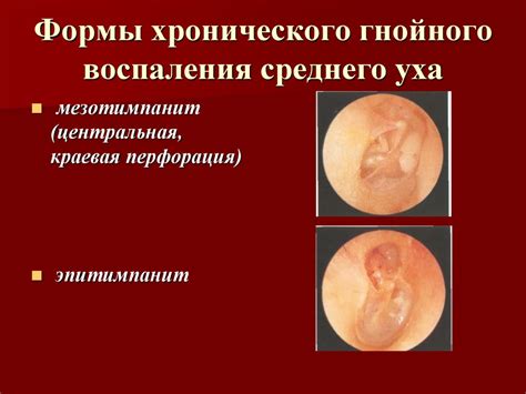 Механизмы развития воспаления среднего уха