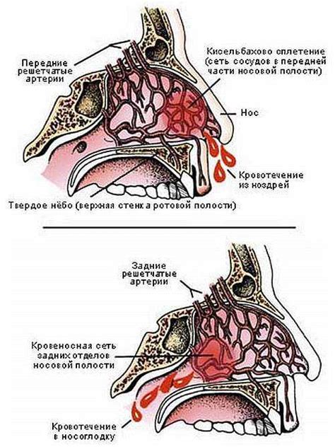 Механизм возникновения носового кровотечения