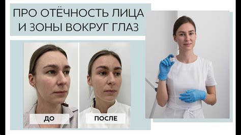 Механизм действия Канефрона на отечность вокруг глаз