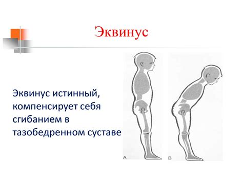Мышечная паралич
