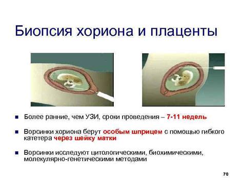 Нарастание плаценты и хориона