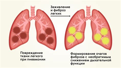 Нарост легкого: причины, симптомы и лечение