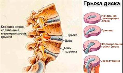 Нарушение статики гоп: что это