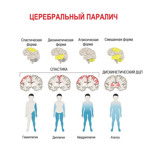 Нарушение церебрального статуса у новорожденного