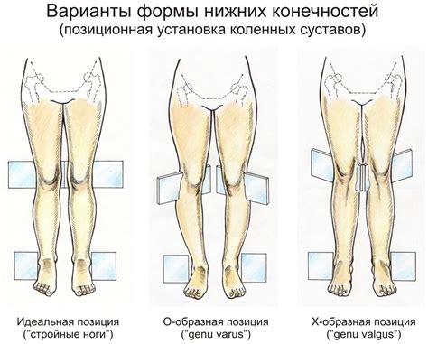 Нехирургические способы исправления искривления нижних конечностей во взрослом возрасте