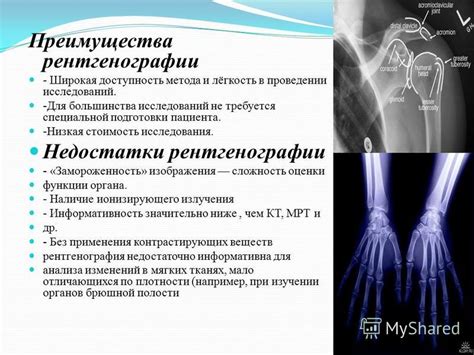 Обзор метода рентгенографии для выявления патологий хрящевой ткани