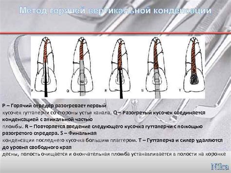 Ограничения использования горячей гуттаперчи