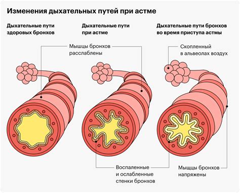 Ограничения при наличии бронхиальной астмы