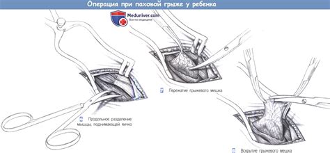 Операция при грыже