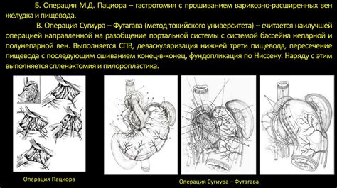 Определение и классификация напряженного асцита