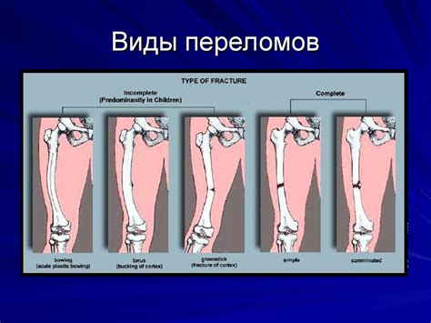 Определение переломов и смещений