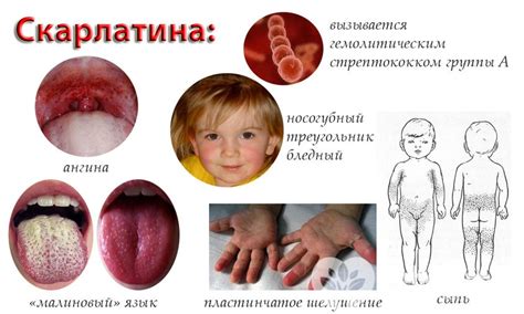 Определение скарлатины и ее дифференциация от других заболеваний горла