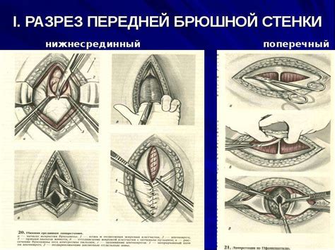 Оптимальное тепловое окружение для успешного кесарева сечения