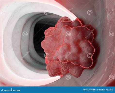 Опухоль в кишечнике