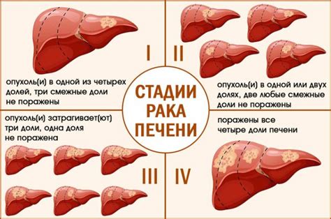 Опухоль печени: причины, симптомы и лечение