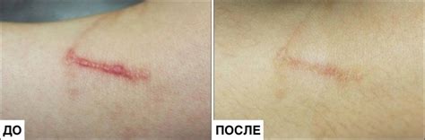 Опции удаления следов на коже: варианты обработки рубцов