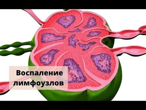 Осложнения воспаления лимфоузлов