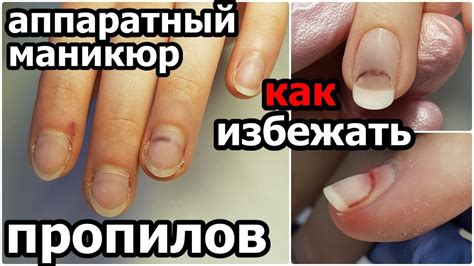 Осложнения гнойничков на ногтях