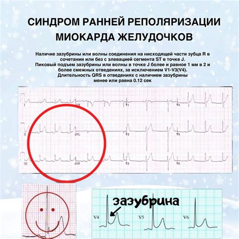 Осложнения нарушения реполяризации миокарда